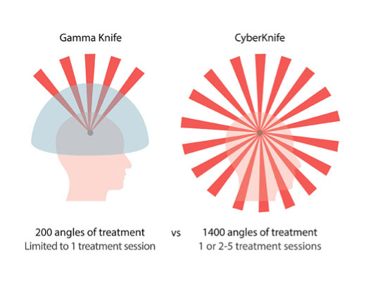 CyberKnife vs Traditional Treatments